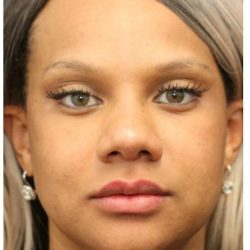 Aesthetic Facial Balancing Before & After Patient #1157