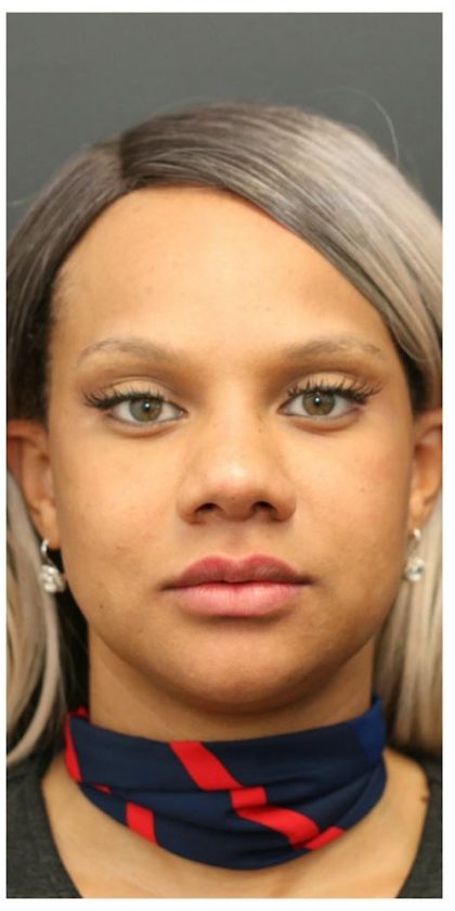 Aesthetic Facial Balancing Before & After Patient #1157