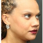 Aesthetic Facial Balancing Before & After Patient #1157
