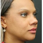 Aesthetic Facial Balancing Before & After Patient #1157