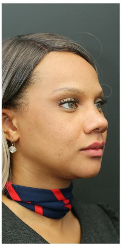 Aesthetic Facial Balancing Before & After Patient #1157