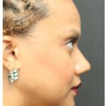 Aesthetic Facial Balancing Before & After Patient #1157