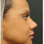 Aesthetic Facial Balancing Before & After Patient #1157