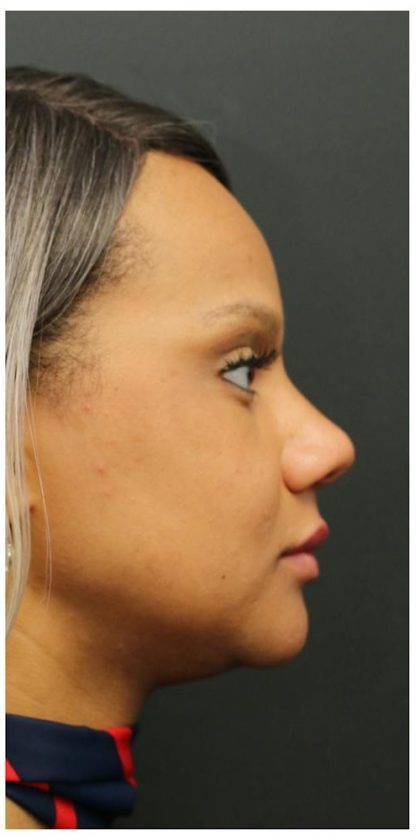 Aesthetic Facial Balancing Before & After Patient #1157