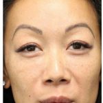 Aesthetic Facial Balancing Before & After Patient #1156