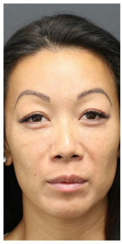 Aesthetic Facial Balancing Before & After Patient #1156