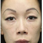Aesthetic Facial Balancing Before & After Patient #1156