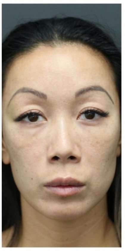 Aesthetic Facial Balancing Before & After Patient #1156