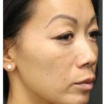 Aesthetic Facial Balancing Before & After Patient #1156