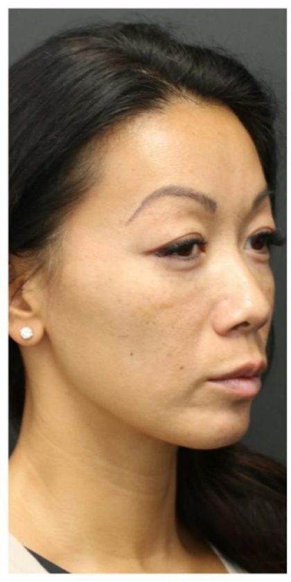 Aesthetic Facial Balancing Before & After Patient #1156