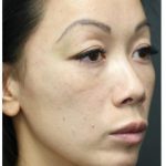 Aesthetic Facial Balancing Before & After Patient #1156