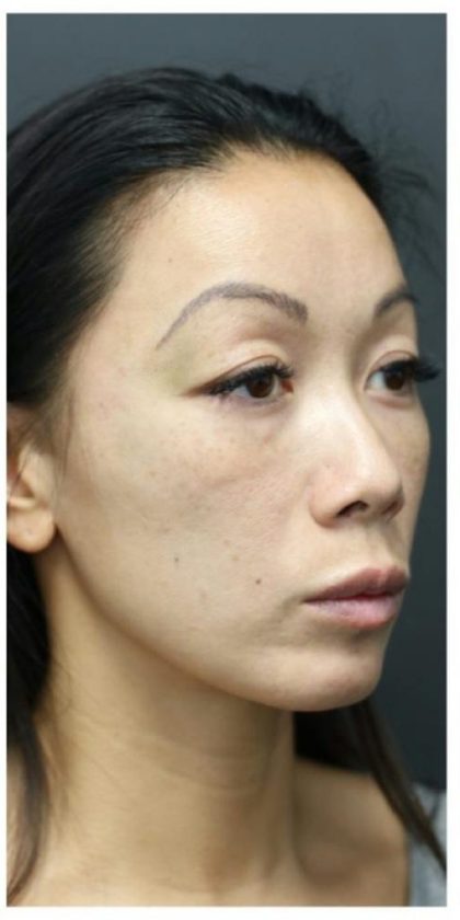 Aesthetic Facial Balancing Before & After Patient #1156