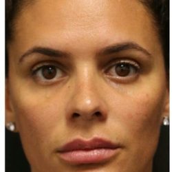 Aesthetic Facial Balancing Before & After Patient #1155
