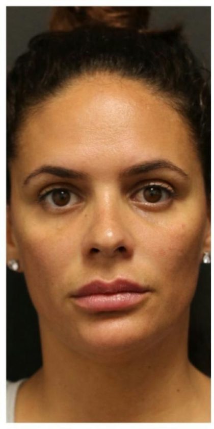 Aesthetic Facial Balancing Before & After Patient #1155