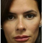 Aesthetic Facial Balancing Before & After Patient #1155