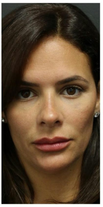 Aesthetic Facial Balancing Before & After Patient #1155