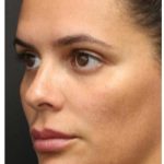 Aesthetic Facial Balancing Before & After Patient #1155