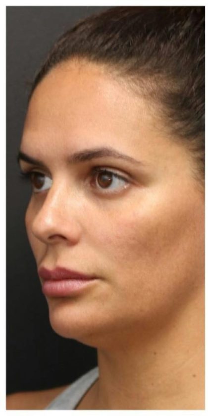 Aesthetic Facial Balancing Before & After Patient #1155
