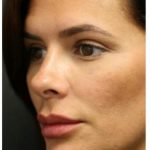 Aesthetic Facial Balancing Before & After Patient #1155