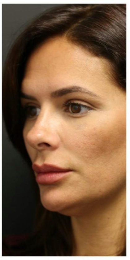 Aesthetic Facial Balancing Before & After Patient #1155
