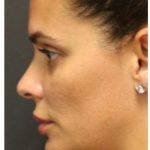 Aesthetic Facial Balancing Before & After Patient #1155