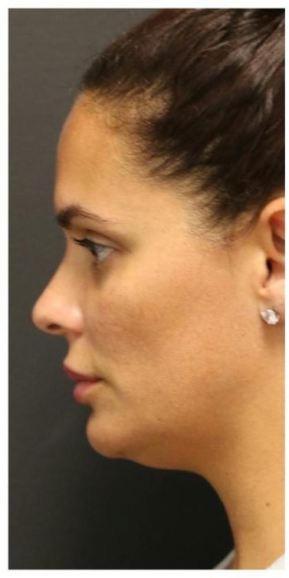 Aesthetic Facial Balancing Before & After Patient #1155