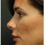 Aesthetic Facial Balancing Before & After Patient #1155
