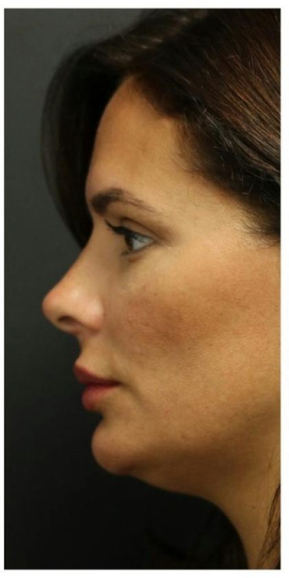Aesthetic Facial Balancing Before & After Patient #1155