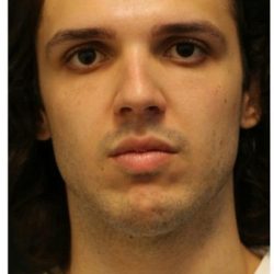 Aesthetic Facial Balancing Before & After Patient #1154