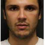 Aesthetic Facial Balancing Before & After Patient #1154