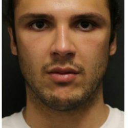 Aesthetic Facial Balancing Before & After Patient #1154