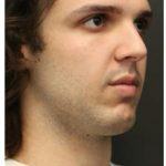 Aesthetic Facial Balancing Before & After Patient #1154