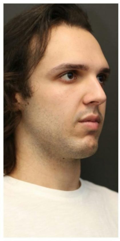 Aesthetic Facial Balancing Before & After Patient #1154
