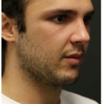 Aesthetic Facial Balancing Before & After Patient #1154