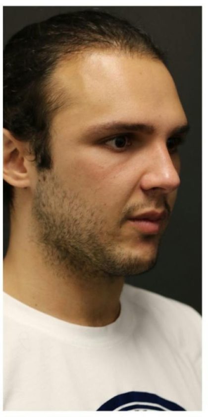 Aesthetic Facial Balancing Before & After Patient #1154