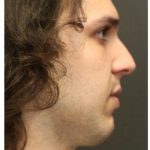 Aesthetic Facial Balancing Before & After Patient #1154