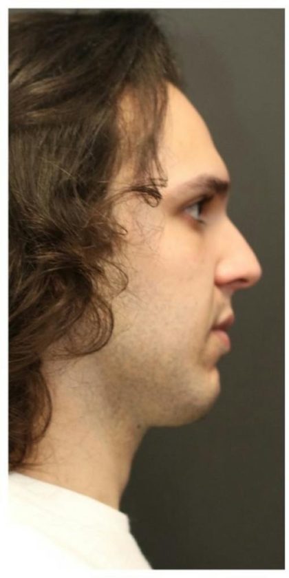 Aesthetic Facial Balancing Before & After Patient #1154