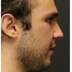 Aesthetic Facial Balancing Before & After Patient #1154