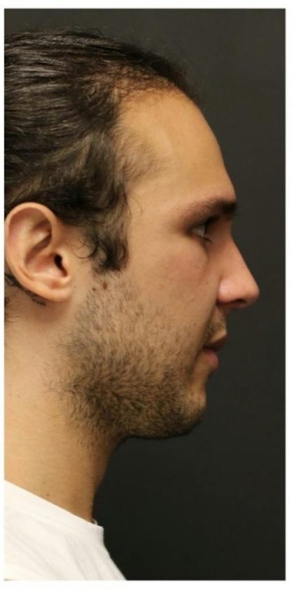 Aesthetic Facial Balancing Before & After Patient #1154