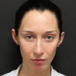 Aesthetic Facial Balancing Before & After Patient #1153