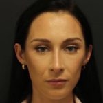 Aesthetic Facial Balancing Before & After Patient #1153