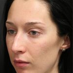 Aesthetic Facial Balancing Before & After Patient #1153
