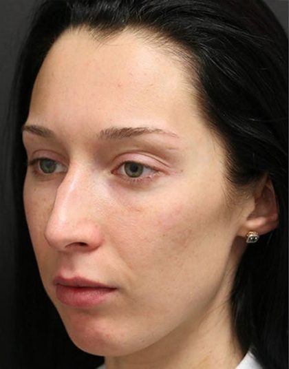 Aesthetic Facial Balancing Before & After Patient #1153