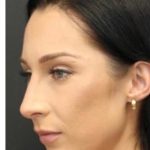 Aesthetic Facial Balancing Before & After Patient #1153