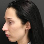 Aesthetic Facial Balancing Before & After Patient #1153