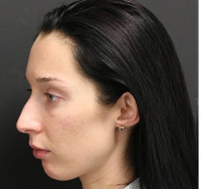 Aesthetic Facial Balancing Before & After Patient #1153