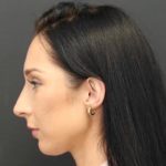 Aesthetic Facial Balancing Before & After Patient #1153