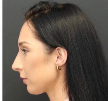 Aesthetic Facial Balancing Before & After Patient #1153