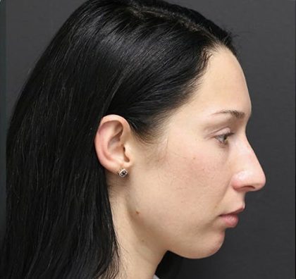 Aesthetic Facial Balancing Before & After Patient #1153