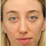 Aesthetic Facial Balancing Before & After Patient #1152